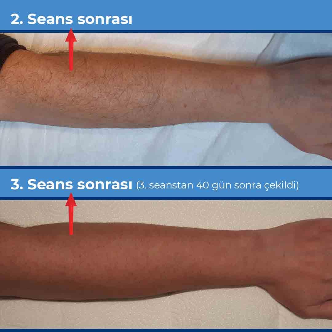 İğneli epilasyon — öncesi/sonrası örnek