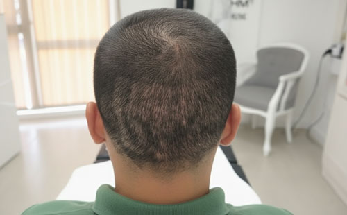 Bölgesel saç dökülmesi örneği